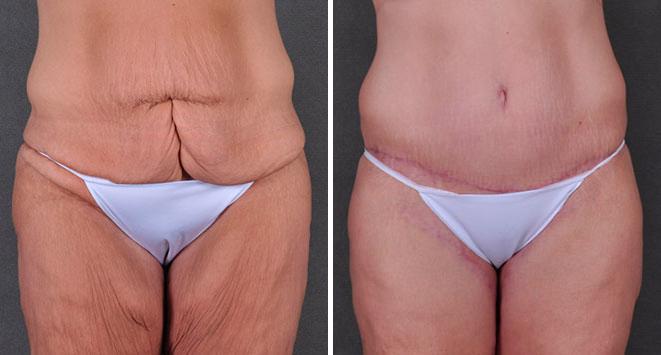 Tummy Tuck Before and After Photos in Omaha, NE, Case 7888