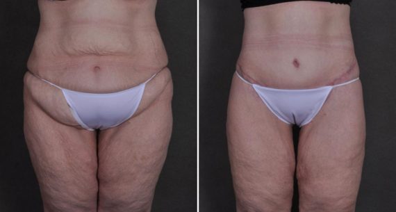 Tummy Tuck Before and After Photos in Omaha, NE, Case 8652