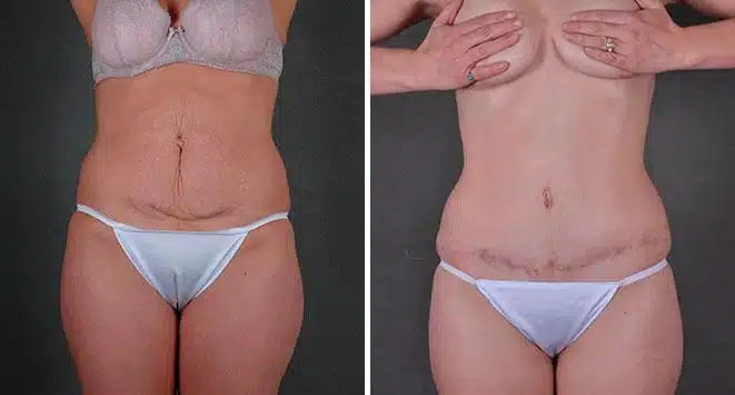 Case 7826, Tummy Tuck Before and After Photos Tummy Tuck Before and After Photos in Omaha, NE, Case 7826