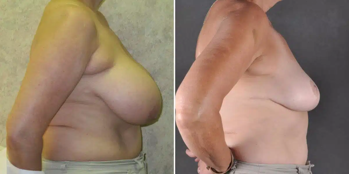 Breast Reduction Before and After Photos in Omaha, NE, Case 7869