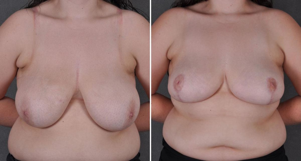 Breast Reduction Before and After Photos in Omaha, NE, Case 8661