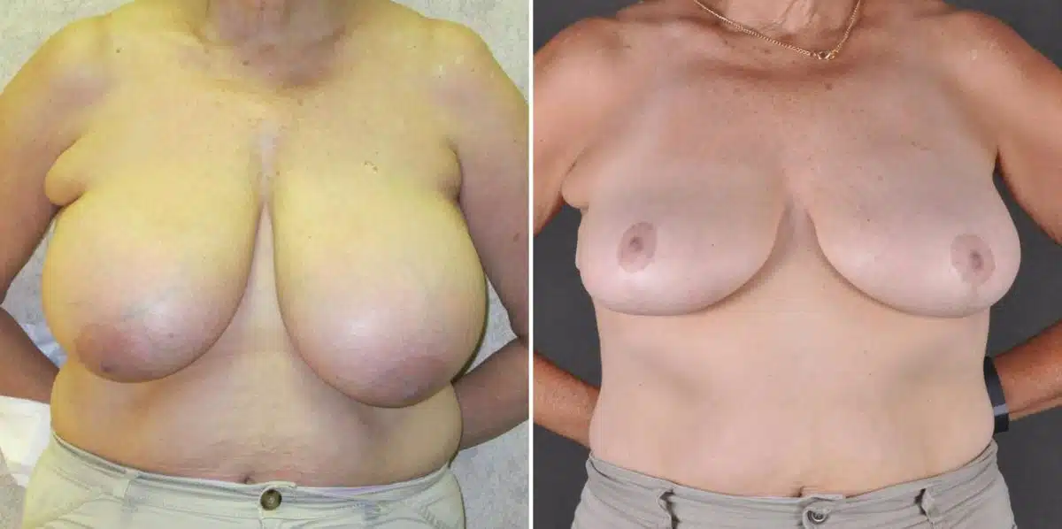 Breast Reduction Before and After Photos in Omaha, NE, Case 7869