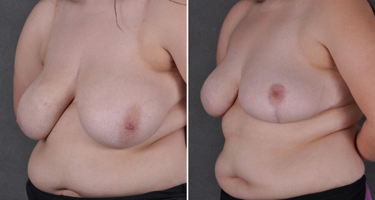 Breast Reduction Before and After Photos in Omaha, NE, Case 8661