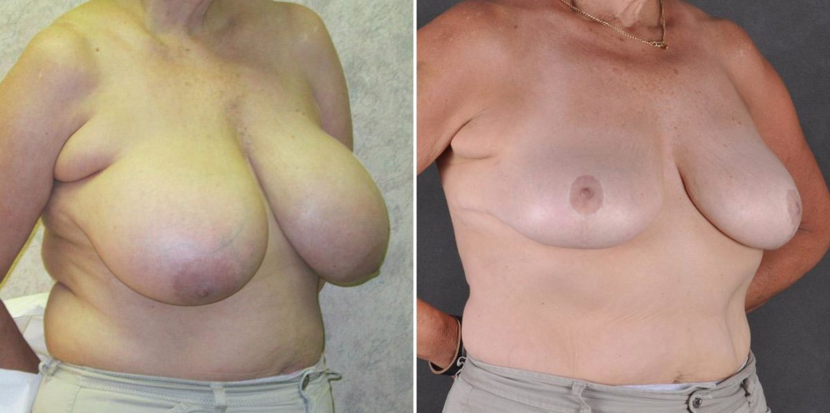 Breast Reduction Before and After Photos in Omaha, NE, Case 7869