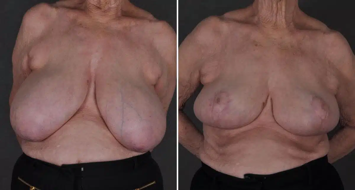 Breast Reduction Before and After Photos in Omaha, NE, Case 8913