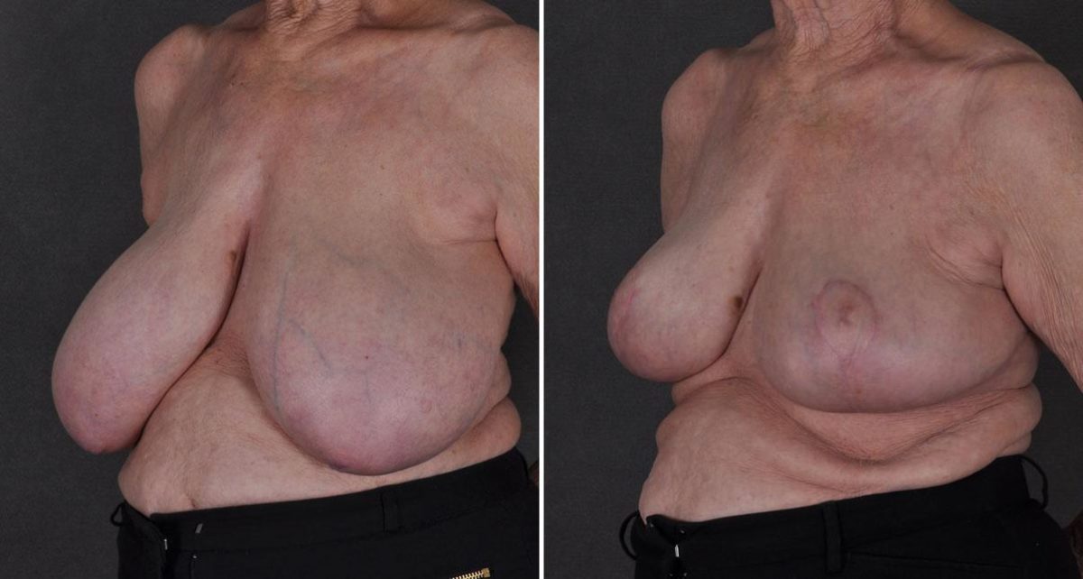 Breast Reduction Before and After Photos in Omaha, NE, Case 8913