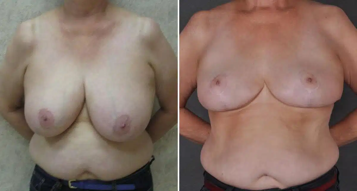 Breast Reduction Before and After Photos in Omaha, NE, Case 9049