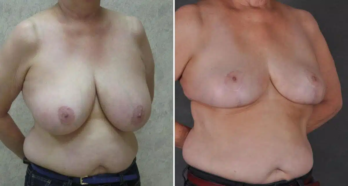 Breast Reduction Before and After Photos in Omaha, NE, Case 9049