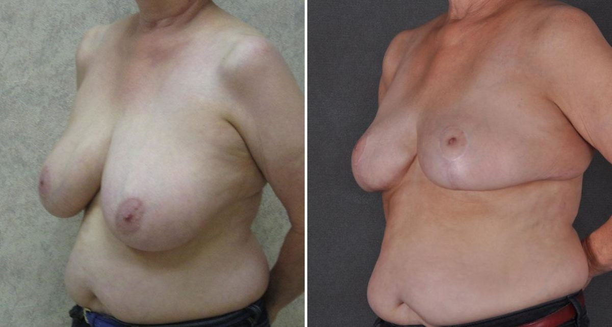 Breast Reduction Before and After Photos in Omaha, NE, Case 9049