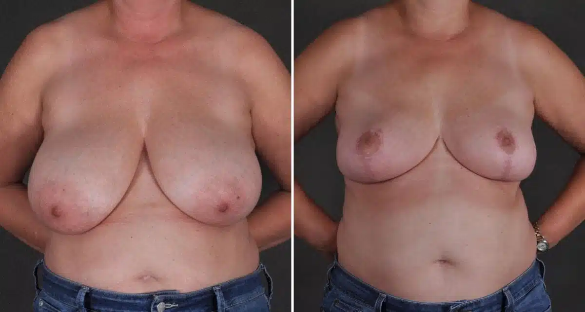 Breast Reduction Before and After Photos in Omaha, NE, Case 9844