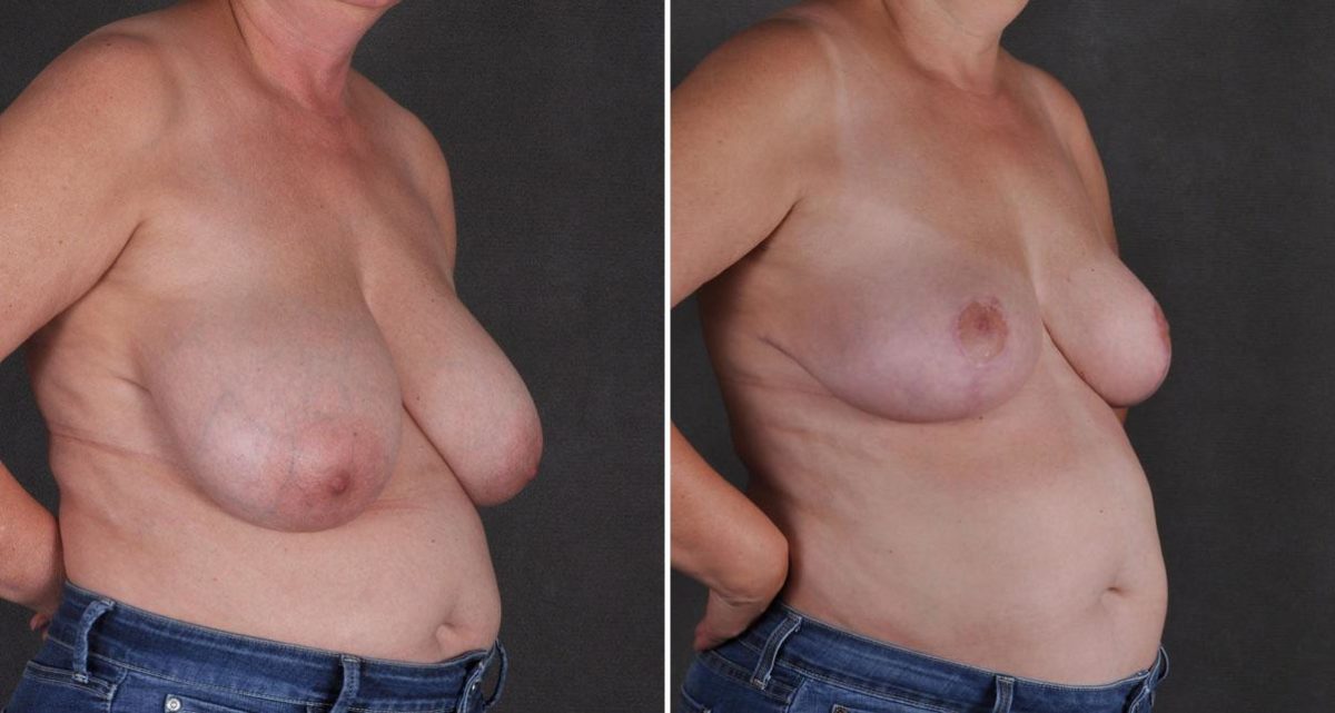 Breast Reduction Before and After Photos in Omaha, NE, Case 9844