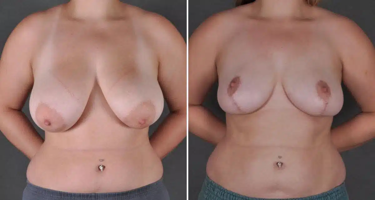 Breast Reduction Before and After Photos in Omaha, NE, Case 8631