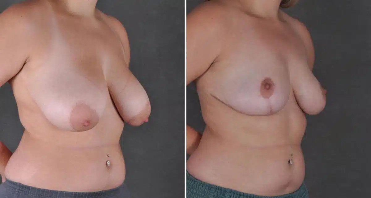 Breast Reduction Before and After Photos in Omaha, NE, Case 8631