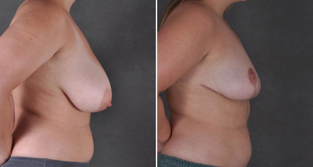 Breast Reduction Before and After Photos in Omaha, NE, Case 8631