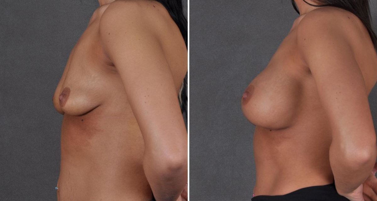 Breast Augmentation Before and After Photos in Omaha, NE, Case 8701