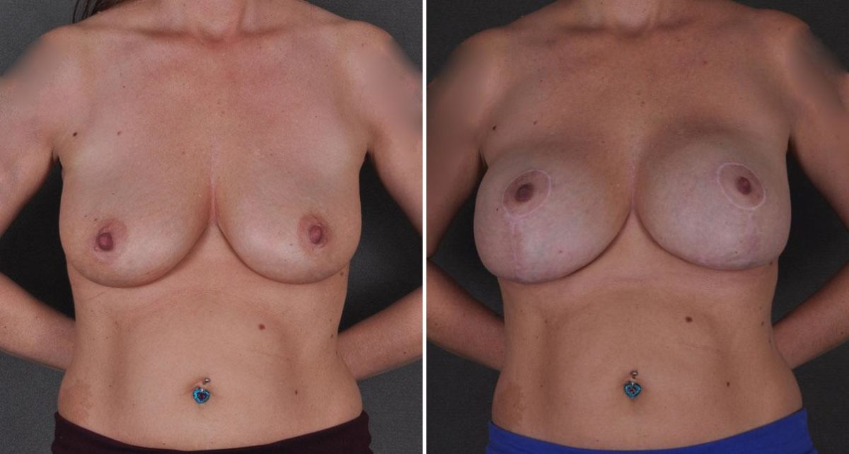 Breast Augmentation Before and After Photos in Omaha, NE, Case 8616