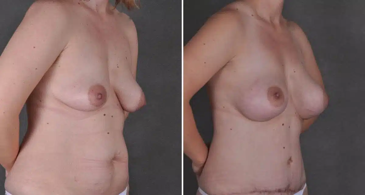 Breast Augmentation Before and After Photos in Omaha, NE, Case 8739