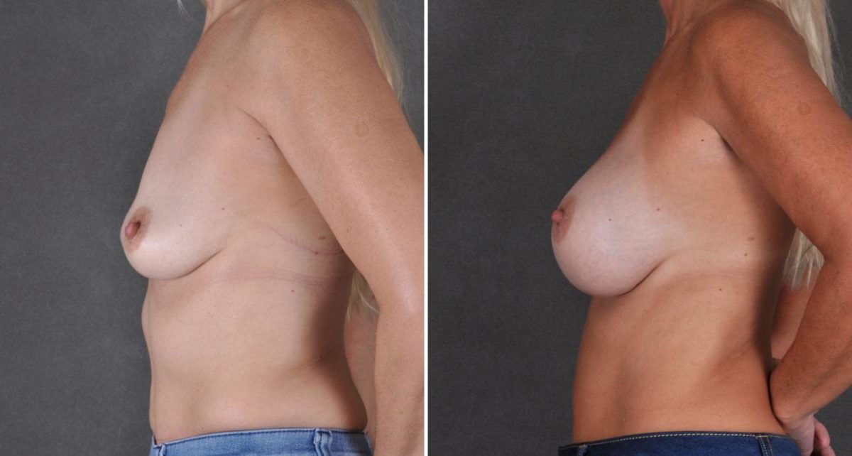 Breast Augmentation Before and After Photos in Omaha, NE, Case 8757