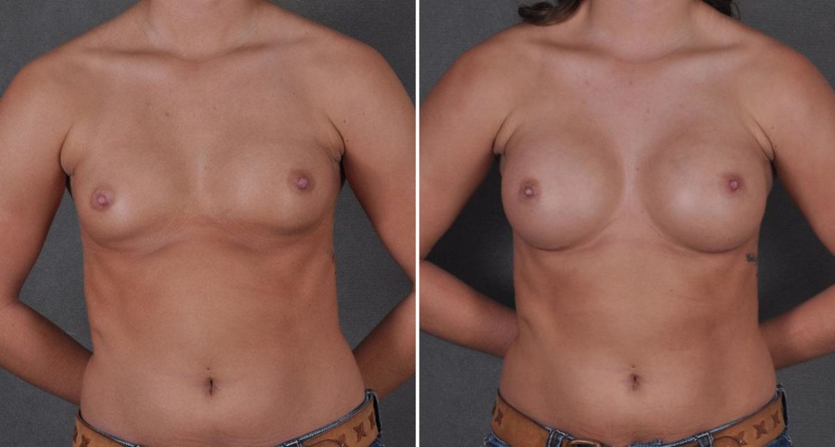 Breast Augmentation Before and After Photos in Omaha, NE, Case 8624