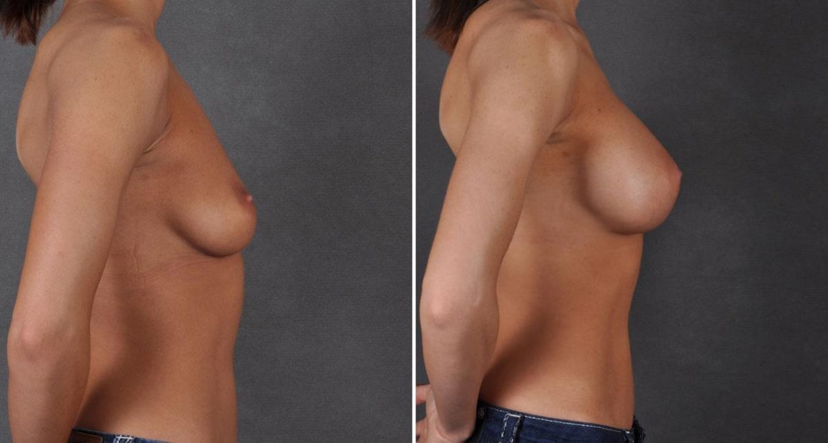 Breast Augmentation Before and After Photos in Omaha, NE, Case 8764