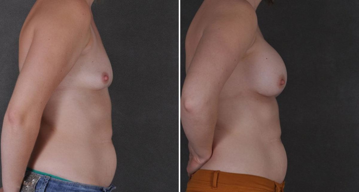 Breast Augmentation Before and After Photos in Omaha, NE, Case 8771