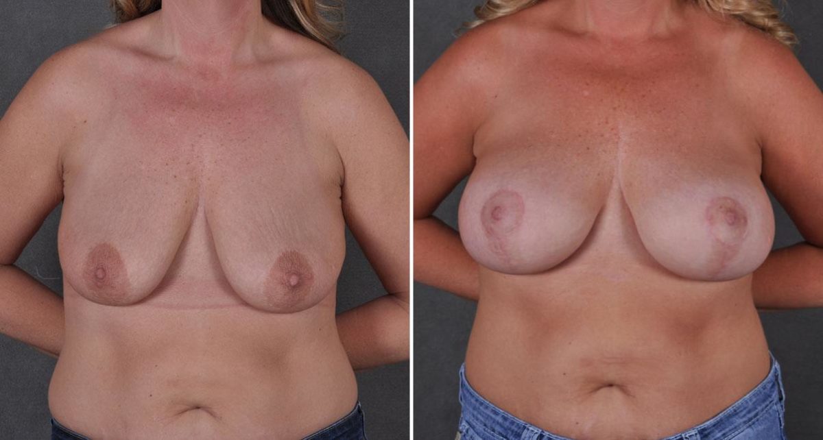 Breast Augmentation Before and After Photos in Omaha, NE, Case 8778