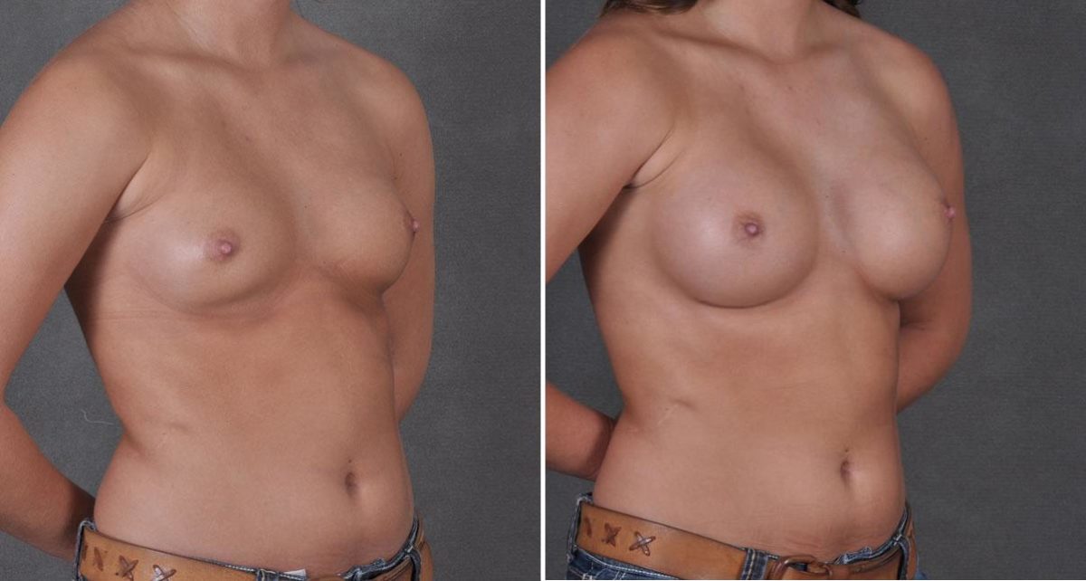 Breast Augmentation Before and After Photos in Omaha, NE, Case 8624