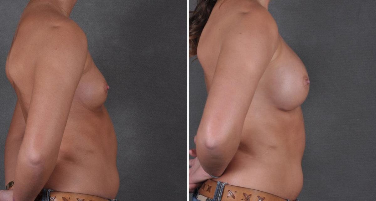 Breast Augmentation Before and After Photos in Omaha, NE, Case 8624