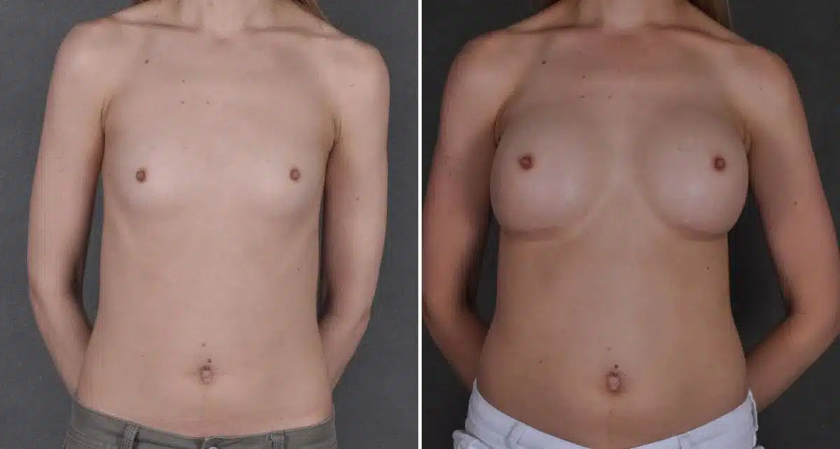 Breast Augmentation Before and After Photos in Omaha, NE, Case 8638