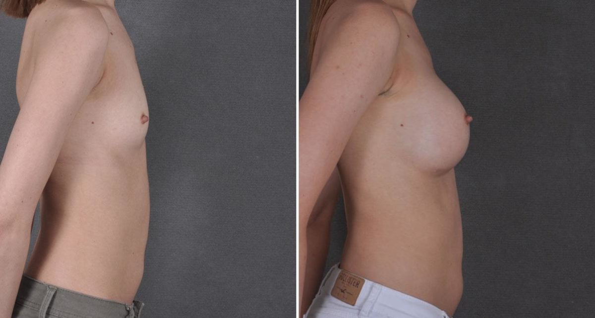 Breast Augmentation Before and After Photos in Omaha, NE, Case 8638