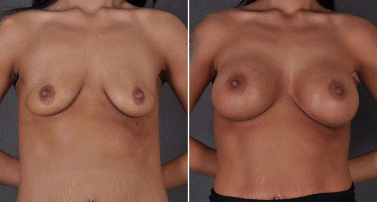 Breast Augmentation Before and After Photos in Omaha, NE, Case 8701