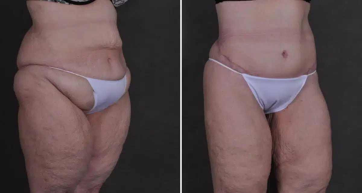 Liposuction Before and After Photos in Omaha, NE, Case 8672