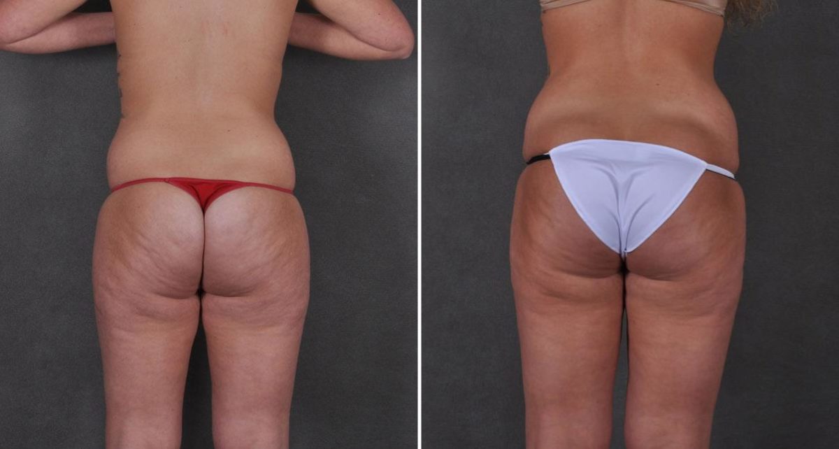 Liposuction Before and After Photos in Omaha, NE, Case 8700