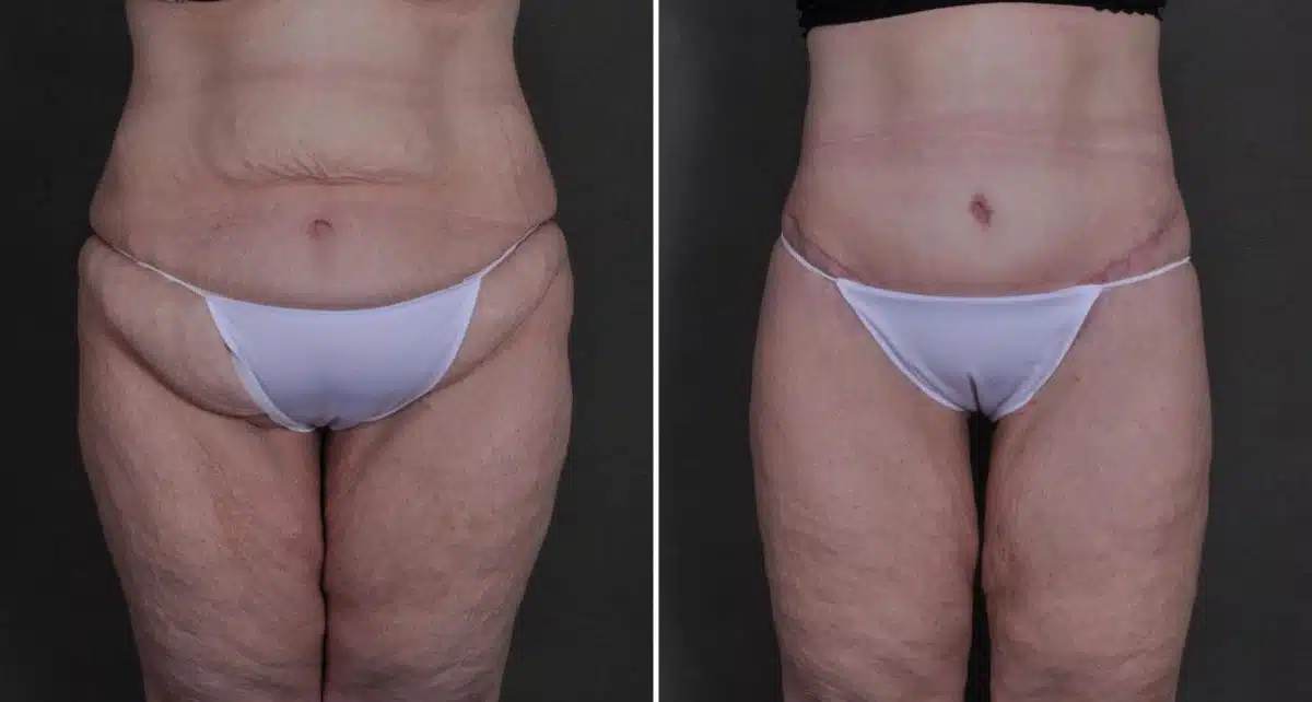 Liposuction Before and After Photos in Omaha, NE, Case 8672