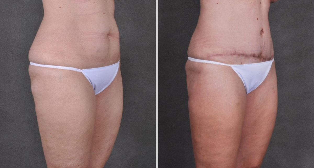 Liposuction Before and After Photos in Omaha, NE, Case 8755