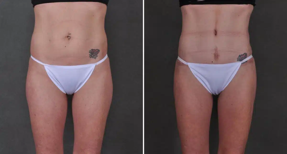 Liposuction Before and After Photos in Omaha, NE, Case 8901