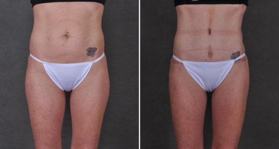 Liposuction Before and After Photos in Omaha, NE, Case 8901