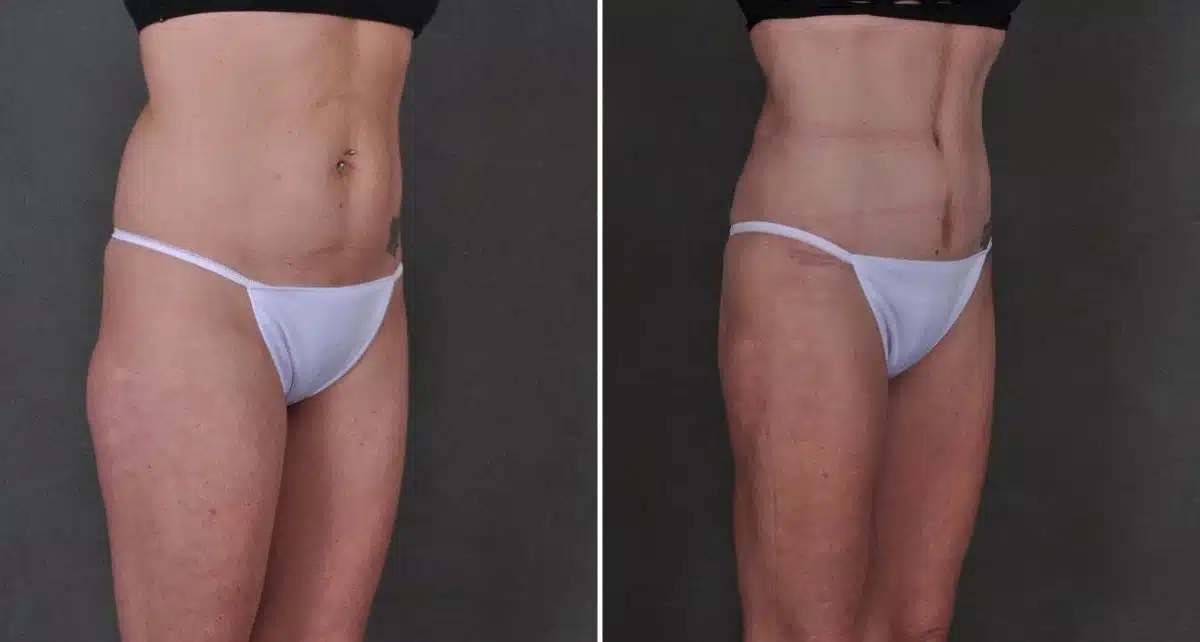 Liposuction Before and After Photos in Omaha, NE, Case 8901