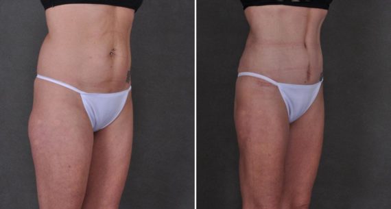 Liposuction Before and After Photos in Omaha, NE, Case 8901