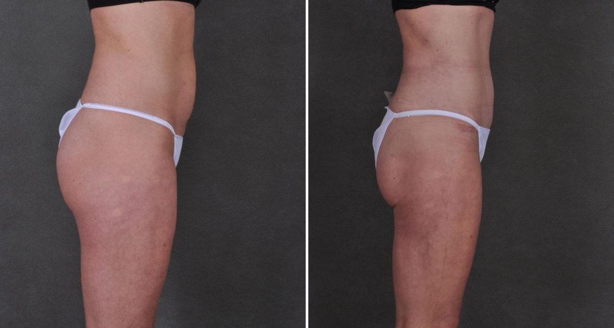 Liposuction Before and After Photos in Omaha, NE, Case 8901