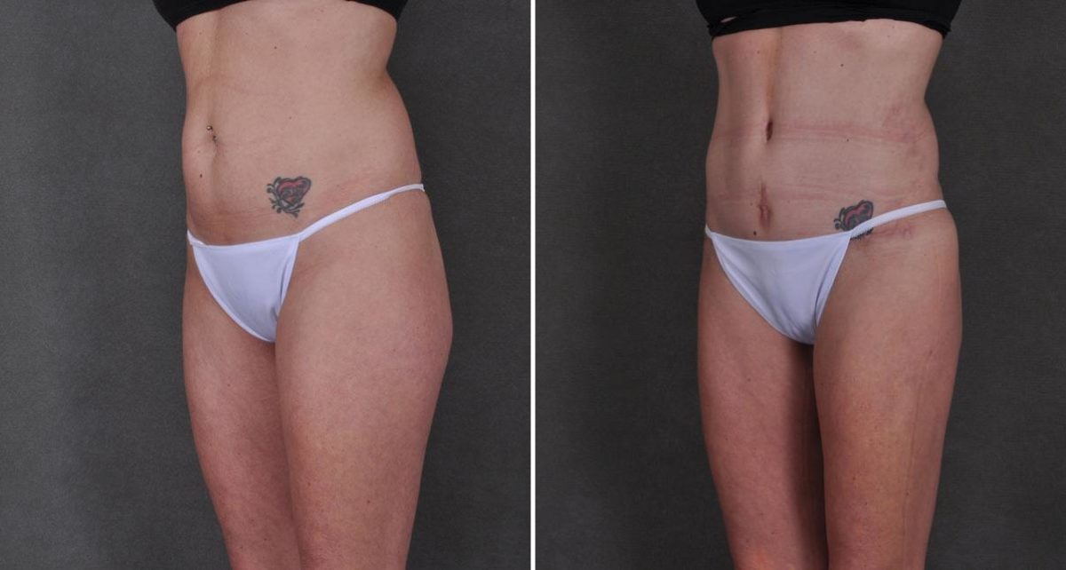 Liposuction Before and After Photos in Omaha, NE, Case 8901