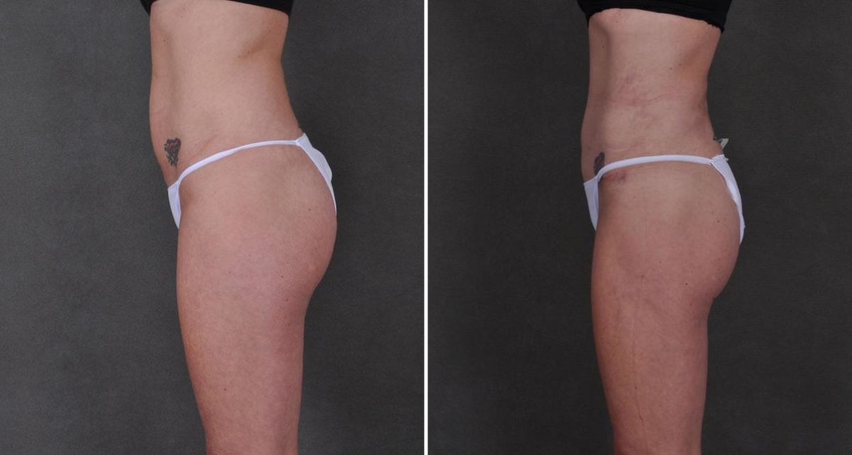 Liposuction Before and After Photos in Omaha, NE, Case 8901