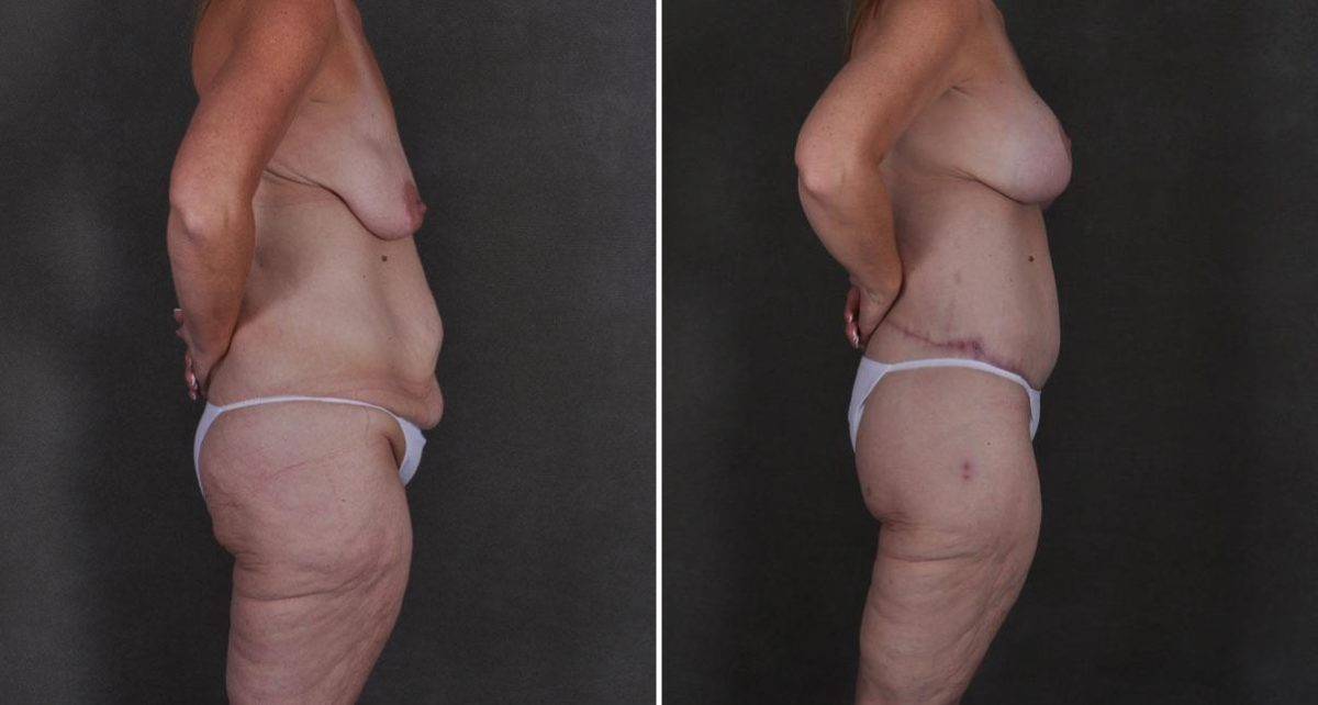 Liposuction Before and After Photos in Omaha, NE, Case 8910