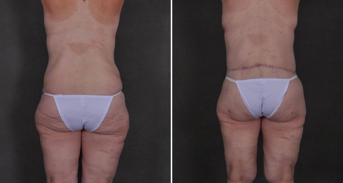 Liposuction Before and After Photos in Omaha, NE, Case 8910