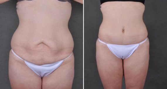 Liposuction Before and After Photos in Omaha, NE, Case 8950