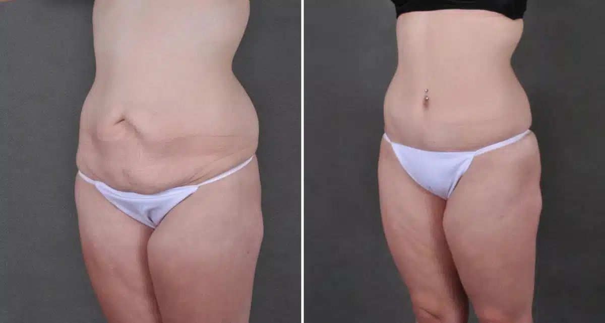 Liposuction Before and After Photos in Omaha, NE, Case 8950