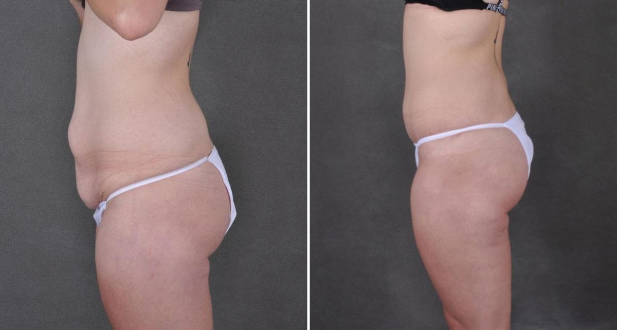 Liposuction Before and After Photos in Omaha, NE, Case 8950