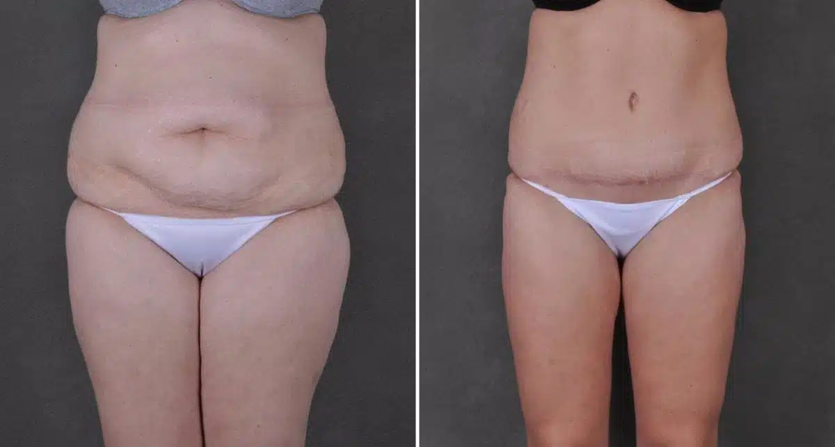 Liposuction Before and After Photos in Omaha, NE, Case 9172