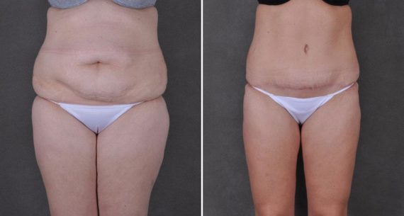 Liposuction Before and After Photos in Omaha, NE, Case 9172