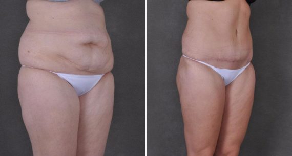 Liposuction Before and After Photos in Omaha, NE, Case 9172